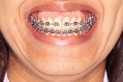 Mostra muita gengiva quando sorri