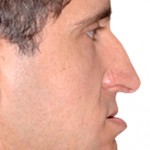 Nariz “grande” e com a ponta caída