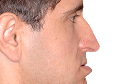 Nariz “grande” e com a ponta caída