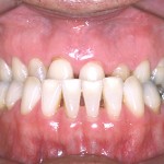 Arcadas dentárias que não encaixam satisfatoriamente