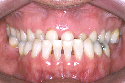 Arcadas dentárias que não encaixam satisfatoriamente