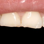 Desgastes dentários prematuros