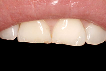 Desgastes dentários prematuros