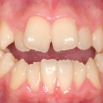 Mastiga de boca aberta