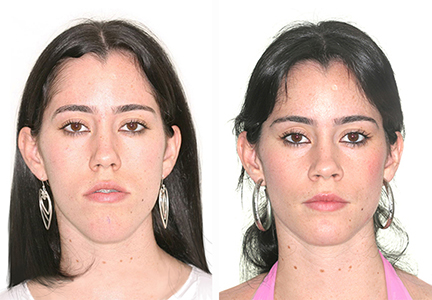 Apresenta uma face alongada