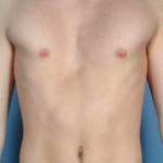 Peito achatado ou profundo