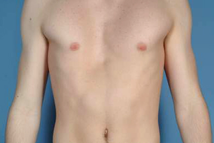 Peito achatado ou profundo