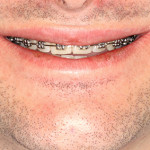 Ao sorrir mostra pouco, quase nada ou nada dos dentes frontais superiores