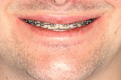 Ao sorrir mostra pouco, quase nada ou nada dos dentes frontais superiores