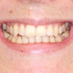 Ao sorrir mostra um corredor bucal amplo ou seja, “um espaço” entre os dentes de trás e a bochecha