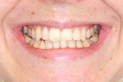 Ao sorrir mostra um corredor bucal amplo ou seja, “um espaço” entre os dentes de trás e a bochecha