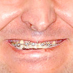 Ao sorrir aparecem sulcos profundos lateralmente ao nariz