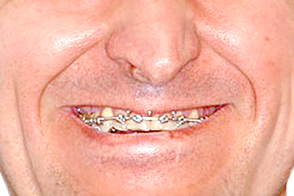 Ao sorrir aparecem sulcos profundos lateralmente ao nariz