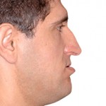 Falta de projeção da “maçã” do rosto