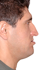 Falta de projeção da “maçã” do rosto