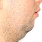 Queixo duplo ou presença de papada entre a ponta do queixo e o pescoço