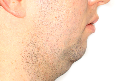 Queixo duplo ou presença de papada entre a ponta do queixo e o pescoço