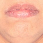 Dificuldade em fechar os lábios passivamente e contrai o músculo do queixo com sinais de “furinhos”