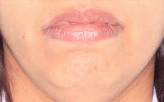 Dificuldade em fechar os lábios passivamente e contrai o músculo do queixo com sinais de “furinhos”